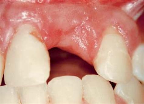 Figure From Surgical Treatment Of Mucogingival Alterations In Cleft