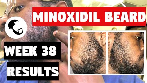 Growing A Beard With Minoxidil A Black Mans Experience Week 38 Youtube