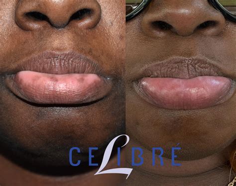 brown spots  lips treatments results    days