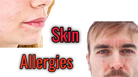 Skin Allergies Types Causes Prevention Youtube