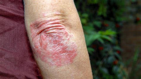 Mild Psoriasis: Pictures, Types, and Symptoms