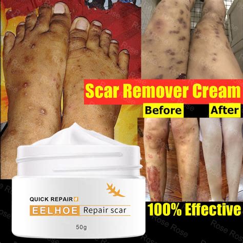 Eelhoe Scar Repair Cream For Old Scar On Leg Stretch Mark Remover Acne