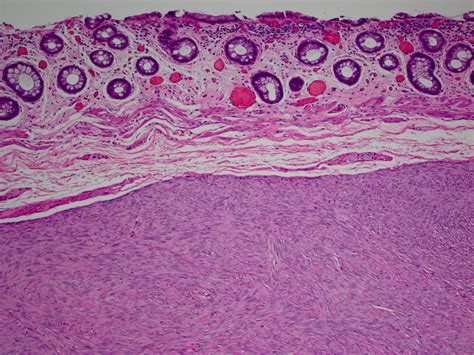 Pathology Outlines Gastrointestinal Stromal Tumor