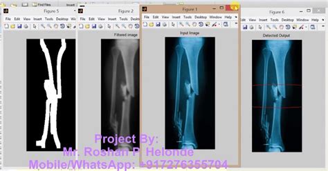 Bone Fracture Detection Using Image Processing Matlab Project With