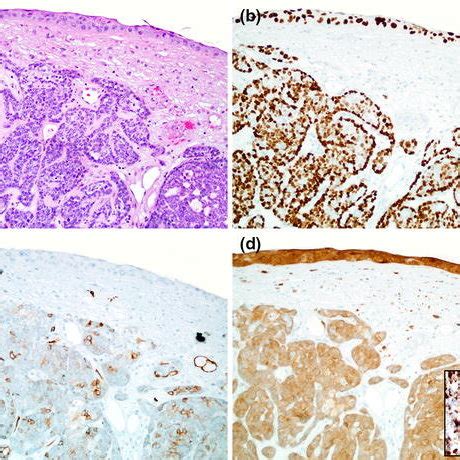 Biphenotypic Sinonasal Sarcoma Is A Highly Cellular Spindle Cell