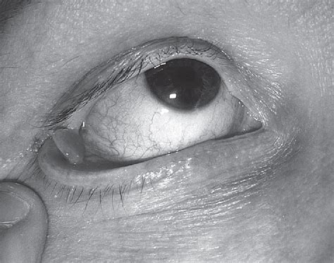 Complications Of The Transconjunctival Approach A Review Of 400 Cases