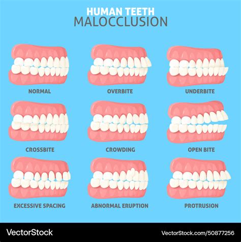 Malocclusion Types Side View Dentist Medical Vector Image