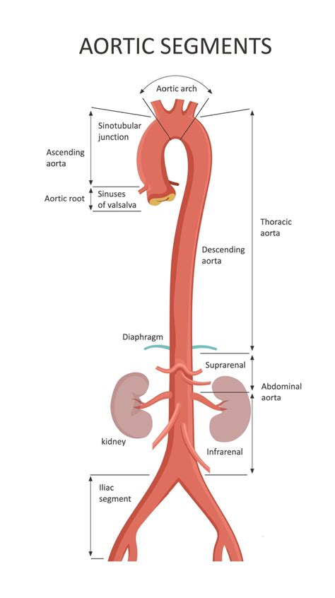 Aneurisma dellaorta addominale cosè e trattamento DossierSalute