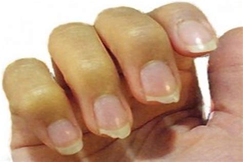 How To Prevent Nail Splitting 3 Effective Remedies Against Nail