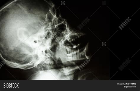 Film X Ray Normal Image And Photo Free Trial Bigstock