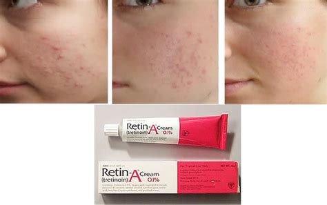 Retinol For Acne Scars - SylviaWeems