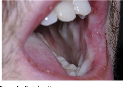 Figure 1 from Rare extrapulmonary complications of Mycoplasma ...