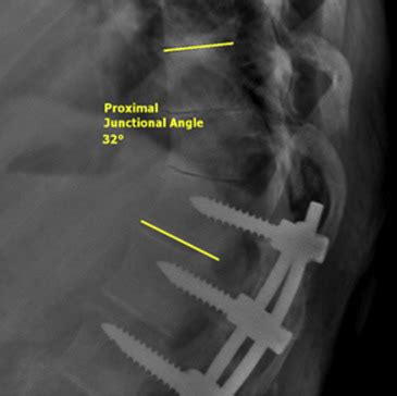 Acute Proximal Junctional Failure In Patients With Preoperative