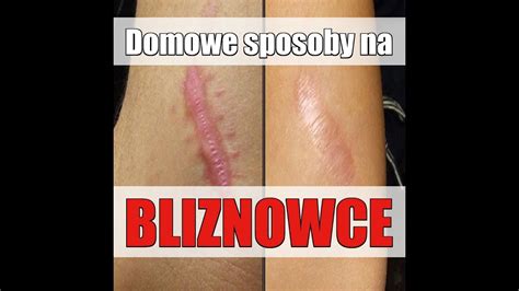 Bliznowce Domowe Sposoby Na Bliznowce Youtube