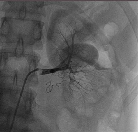 Selective Left Renal Angiography Was Done And Suggested Pseudoaneurysm