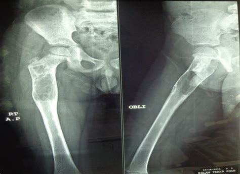 ]: Preoperative x-ray femur [10 years old child], anteroposterior and ...