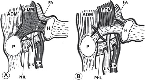 Anatomy of Guyon's canal - a systematic review. | Semantic Scholar