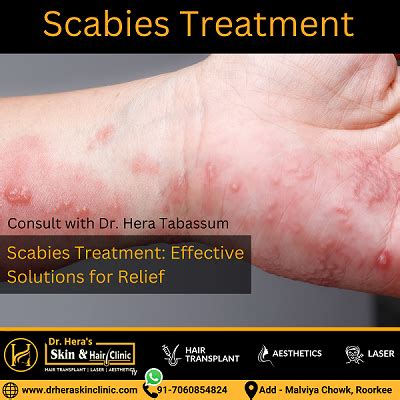 Scabies Treatment at Dr Hera Skin & Hair Clinic - Dermatologist in Roorkee