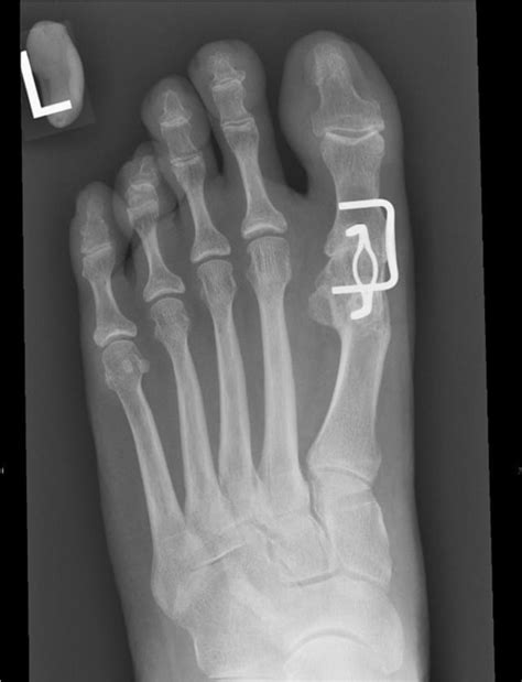 First Metatarsophalangeal Joint Fusion With Orthogonal Memory Staple