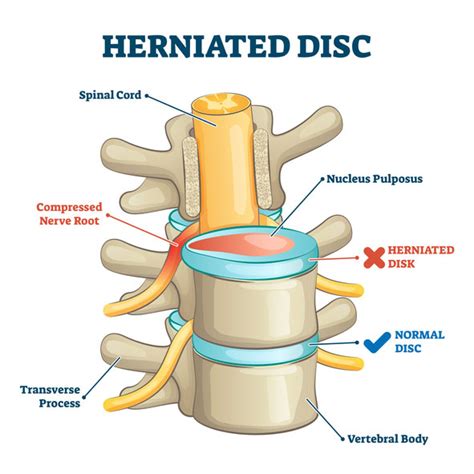 Spinal Decompression Columbia City IN | Whitley Chiropractic