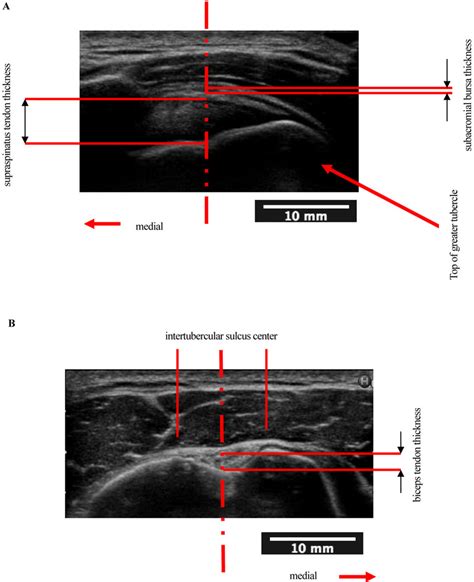 The Ultrasound Measurement Of Thickness A The Ultrasound Measurement