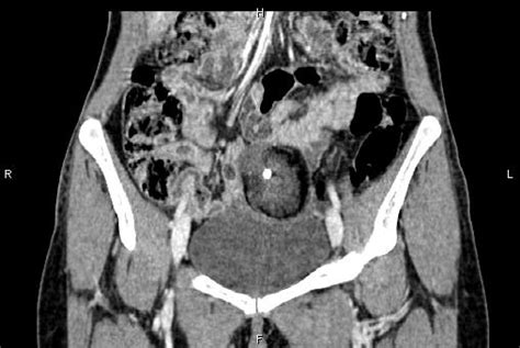 Ovarian Mature Cystic Teratoma Image