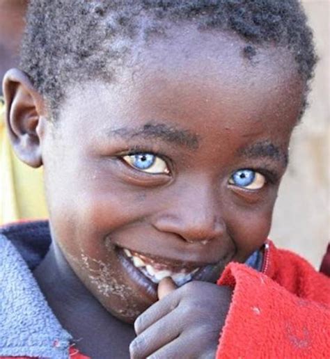 Menino Africano Nasce Com Olhos Azuis E é Chamado De Olhos De Safira