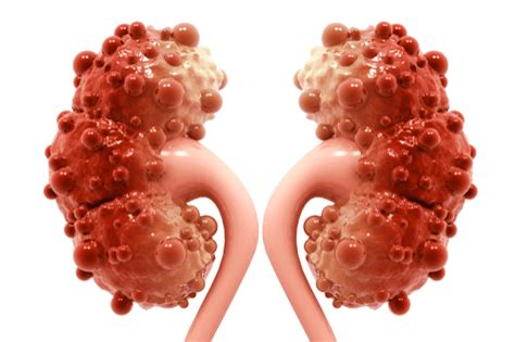 Polycystic Kidney Disease: Symptoms, causes, & complications | FactDr