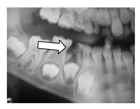 Paediatric Endo Pulpotomy Not Finished Flashcards Quizlet