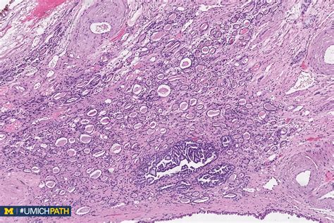 Michigan Pathology On Twitter Here Is A Photo Of The Adjacent