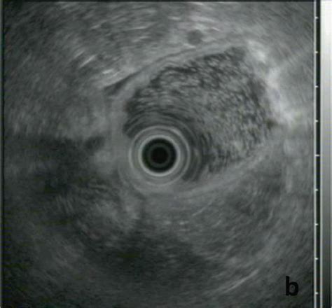 A Radial Eus Imaging Of The Gastric Wall Notice The Normal 5 Layer Download Scientific