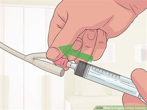 How to Irrigate a Foley Catheter (with Pictures) - wikiHow