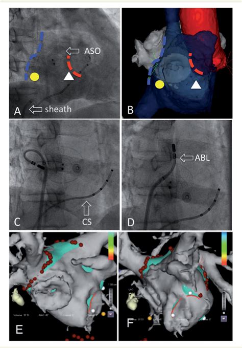 Figure From Transseptal Puncture And Catheter Ablation Of Atrial