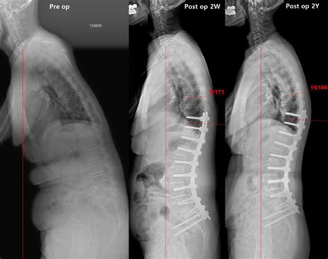 Effect Of Overcorrection On Proximal Junctional Kyphosis In Adult