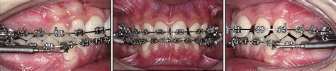 Combined Orthodontic Orthopedic Treatment Of An Adolescent Class Ii