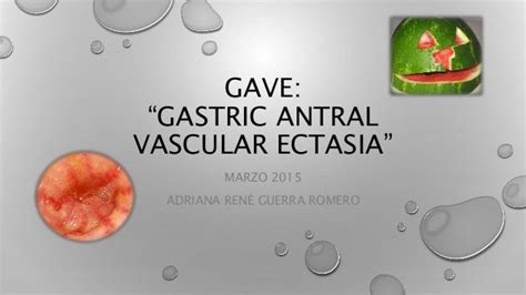 GASTRIC ANTRAL VASCULAR ECTASIA