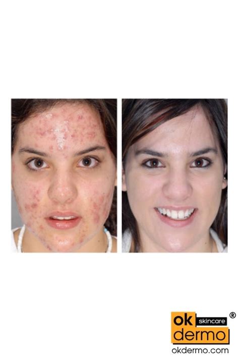 Tretinoin Before After, Before and after month 2 on 05% tretinoin cream ...