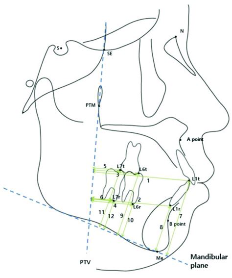 Cephalometric Dental Linear Measurements Of Mandible Horizontal