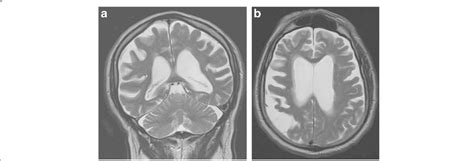 Atrophy And Extensive Gliosis Of The Left Frontoparietal Region In