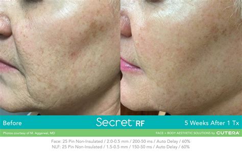 Secret Radio Frequency Microneedling Dartmouth Dermatology