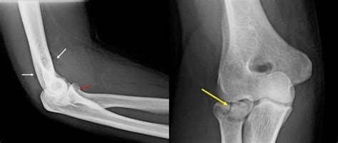 Fracture Of Radial Head A Minimally Displaced Fracture Is Seen