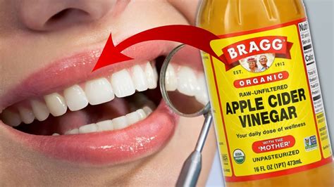 What Apple Cider Vinegar Does To Your Teeth YouTube