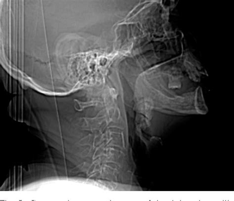 Chronic Sclerosing Sialadenitis Or Küttners Tumor Associated With A