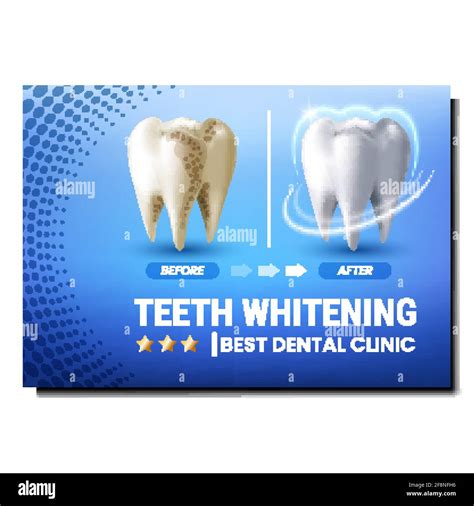 Teeth Whitening Creative Promotional Poster Vector Stock Vector Image & Art - Alamy