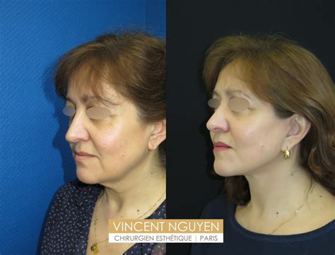 Chirurgien Esthétique Plastique Reconstructrice Paris Dr Nguyen