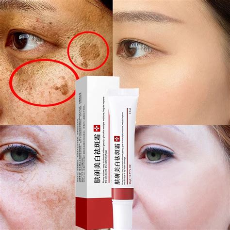 Effective Whitening Cream Freckle Remove Dark Spots Fade Acne Scars