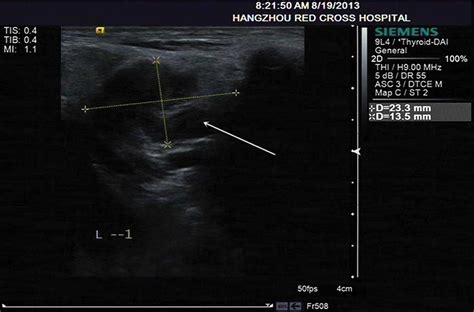 Are shotty lymph nodes normal - hacmarkets