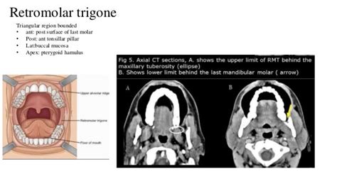 Retromolar Trigone Anatomy