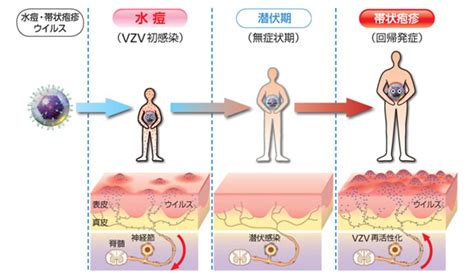 帯状疱疹の病態 マルホ 医療関係者向けサイト