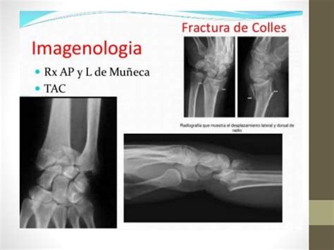 Fracturas De Radio Distal Ppt